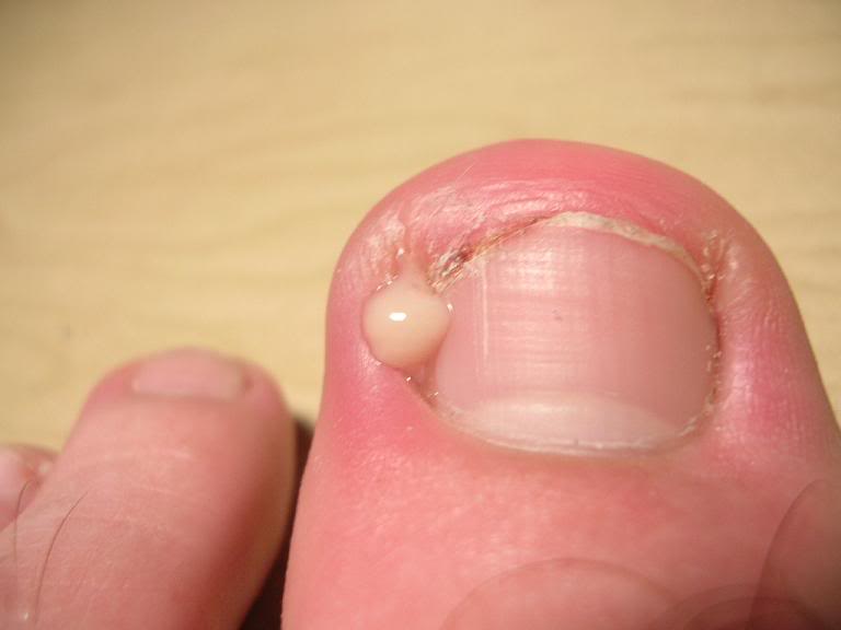 ingrown toenail spur